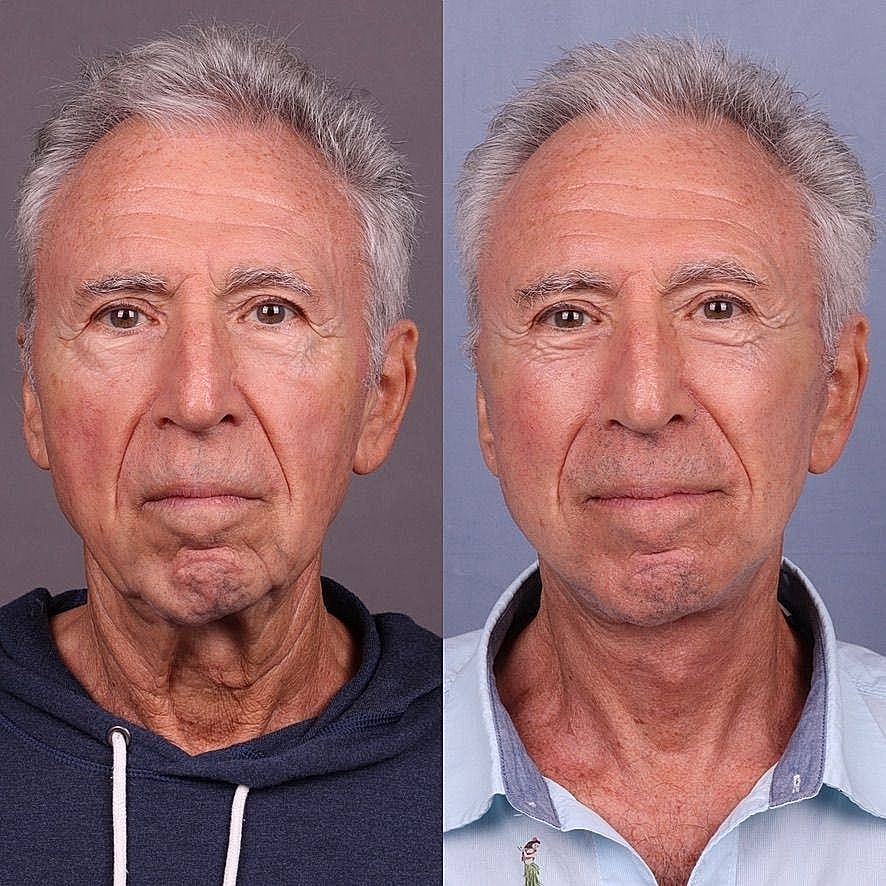 Before and after aging skin treatment comparison.