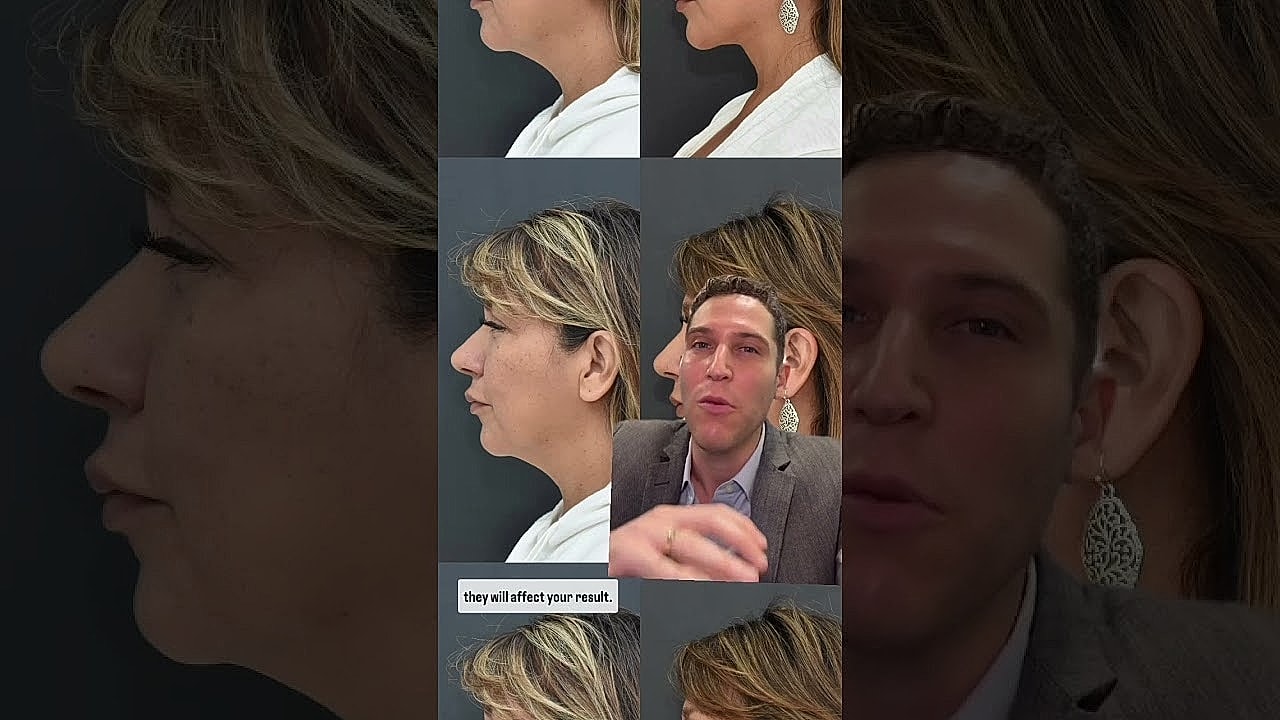 How Long Does a Facelift Last?