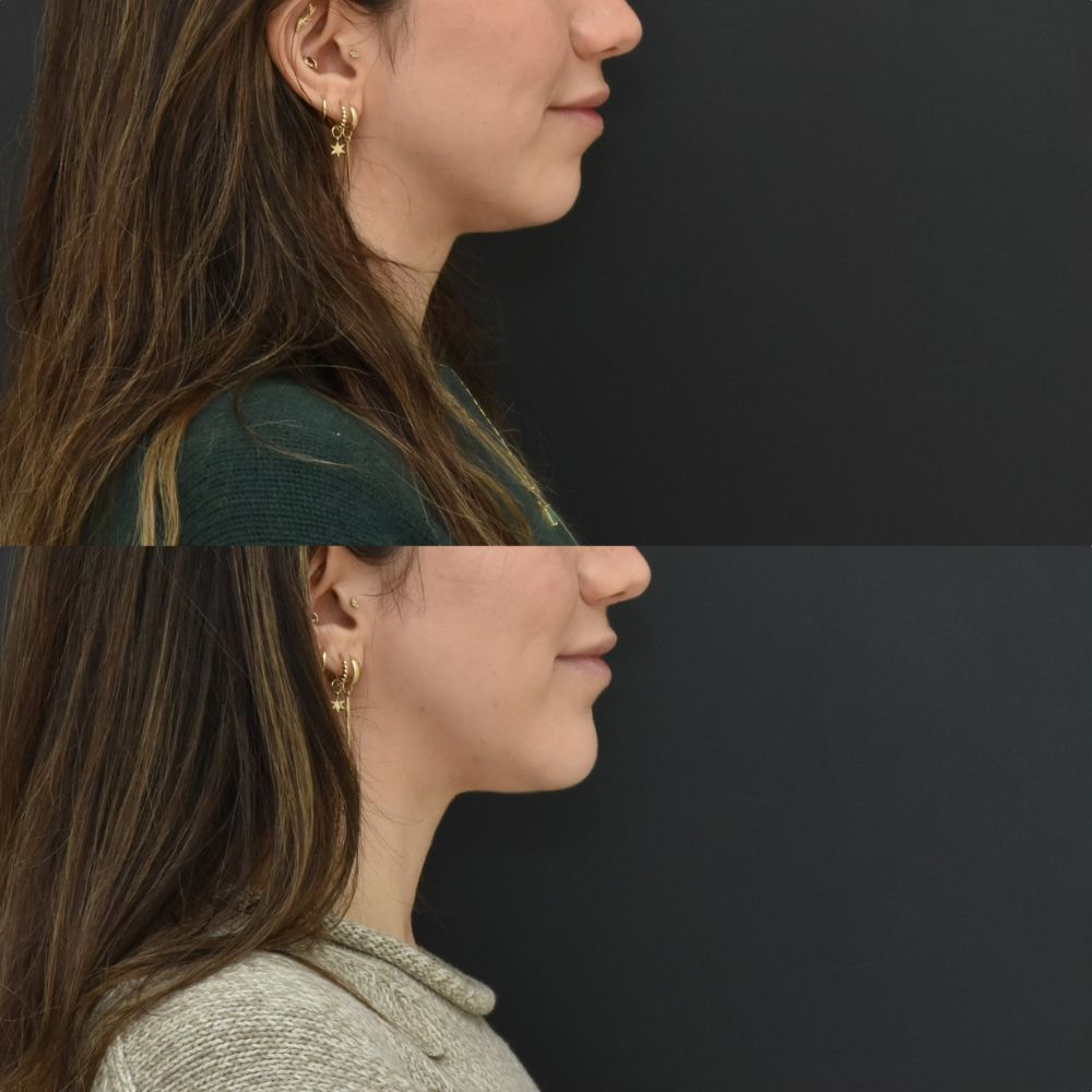 Profile views of a woman wearing earrings.