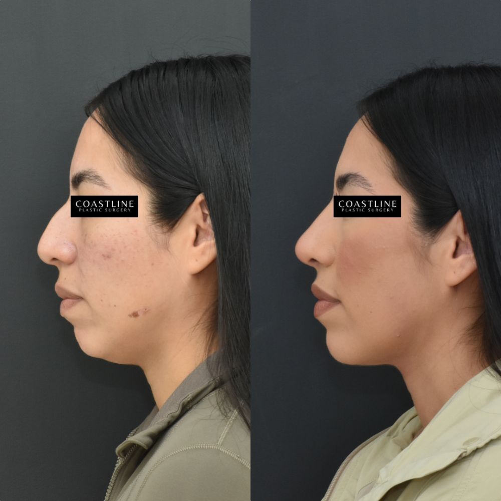 Before and after plastic surgery profile comparison
