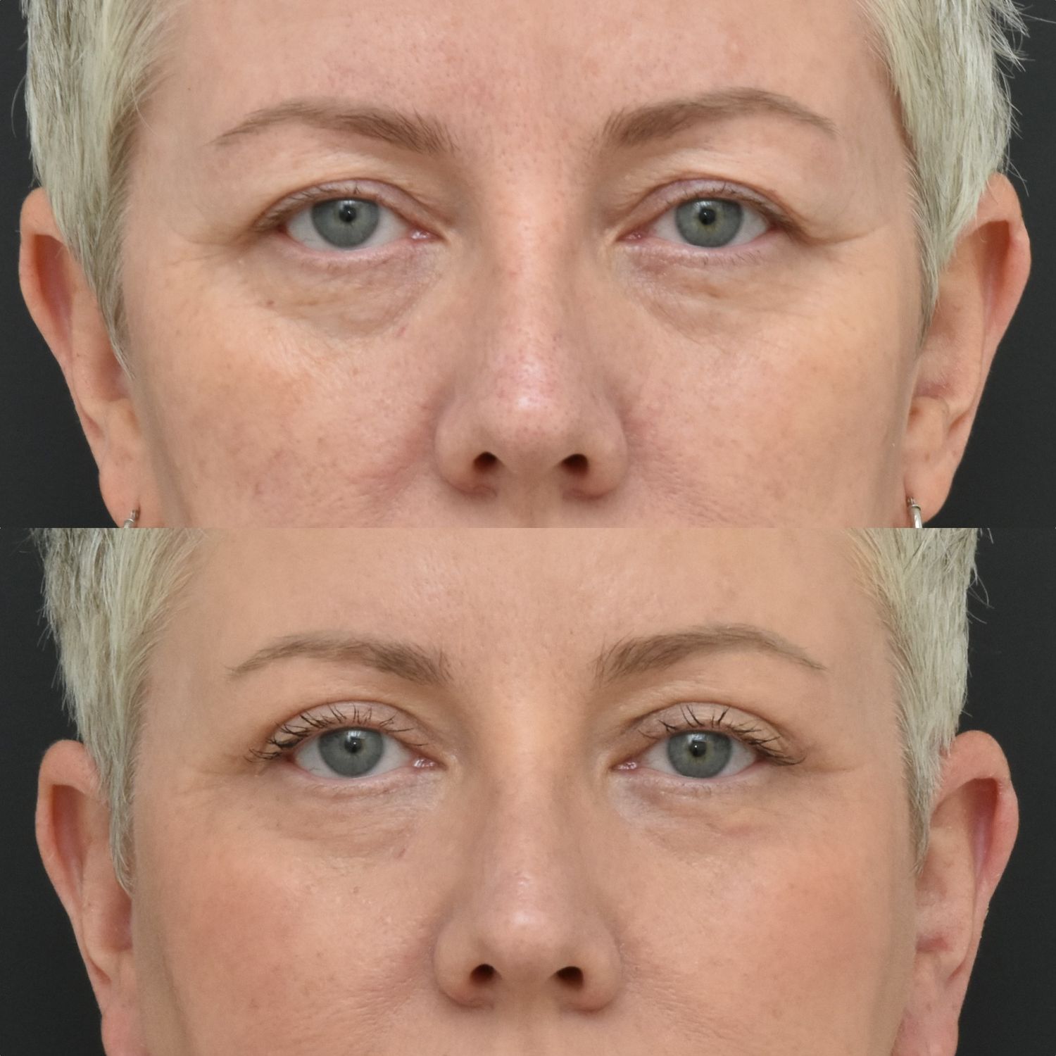 Before and after skin treatment comparison.