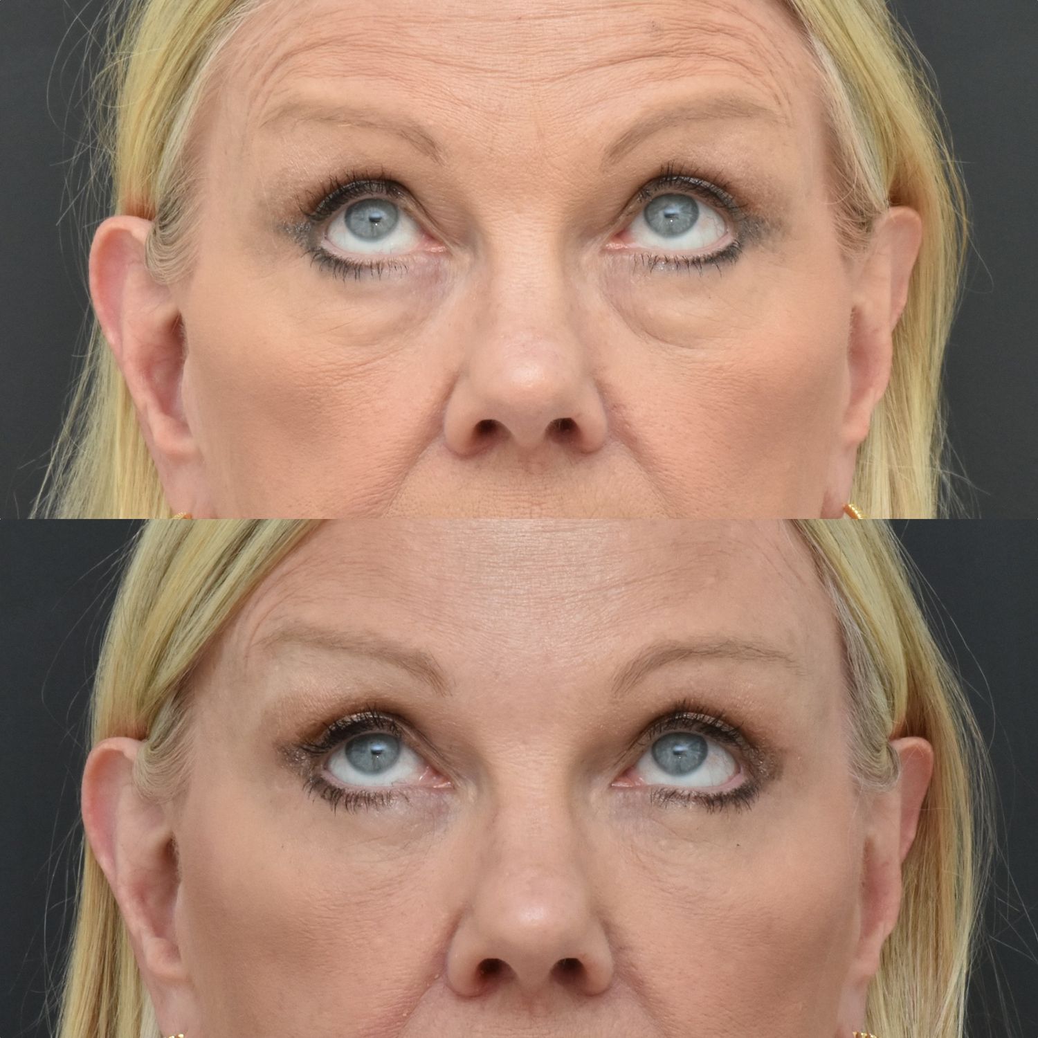 Before and after eye treatment comparison image