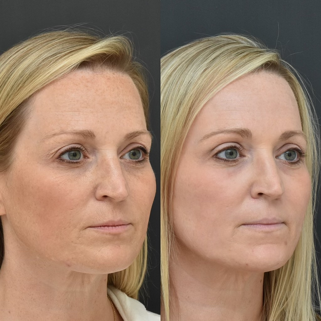 Before and after facial treatment comparison.