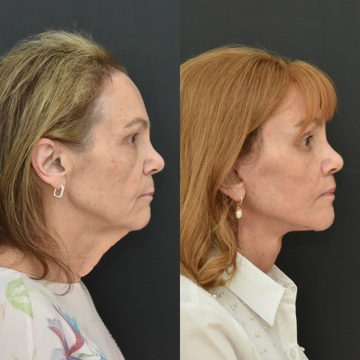 Before and after facial treatment comparison.