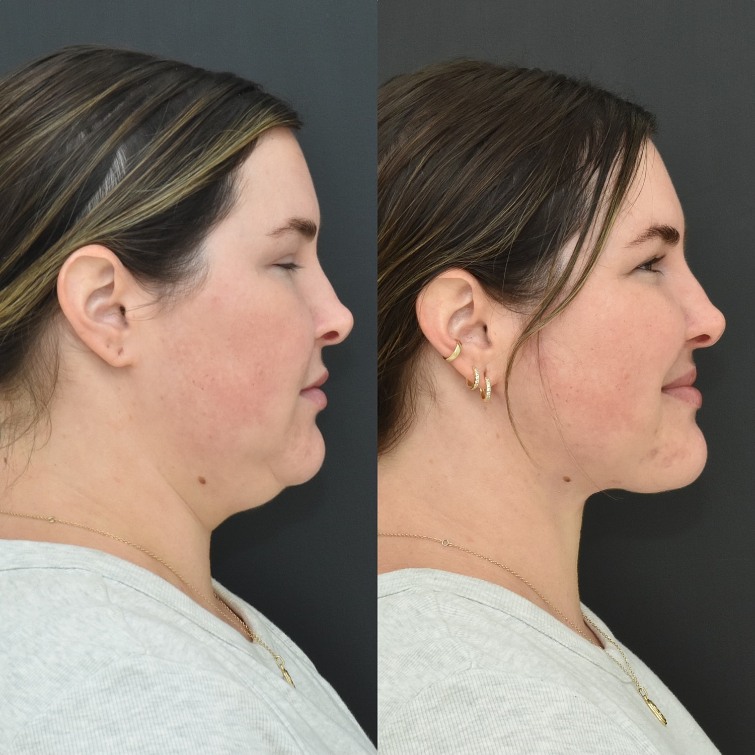 Buccal Fat Removal Before & After