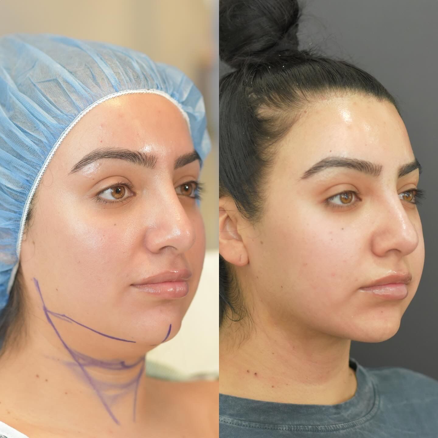 Buccal Fat Removal Before & After