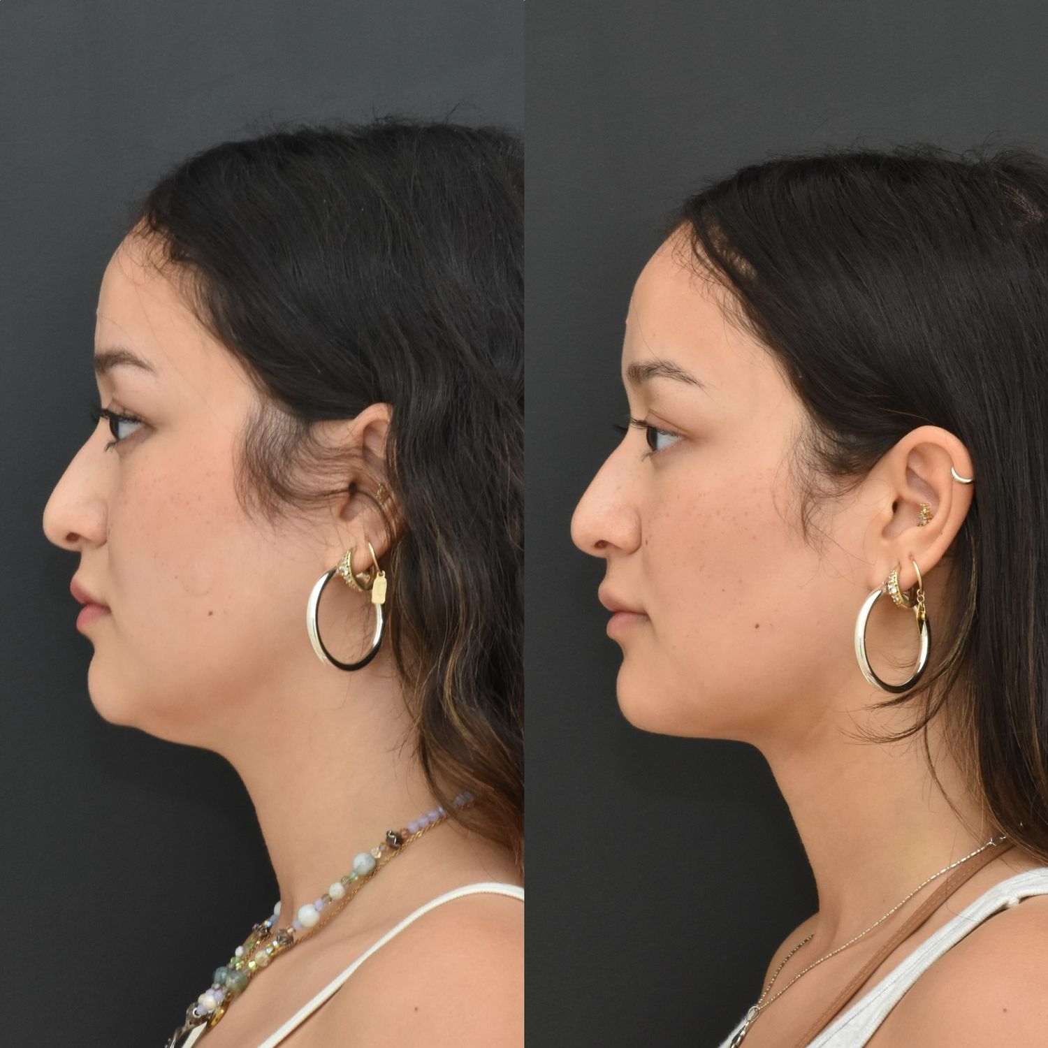 Buccal Fat Removal Before & After