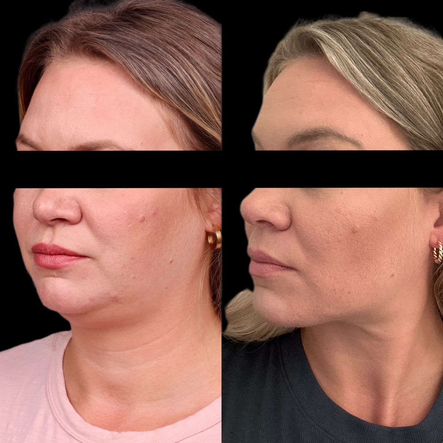Buccal Fat Removal Before & After