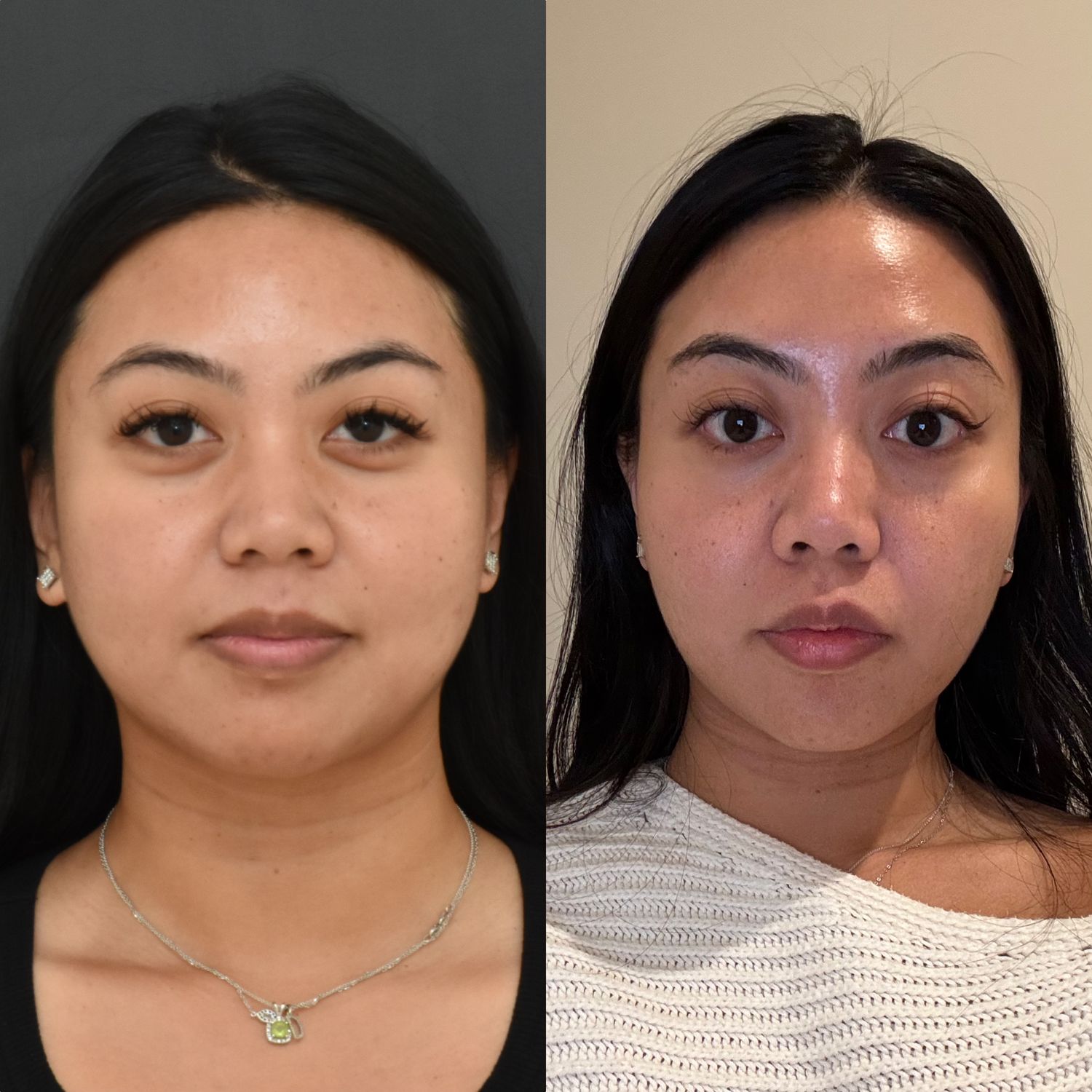 Buccal Fat Removal Before & After