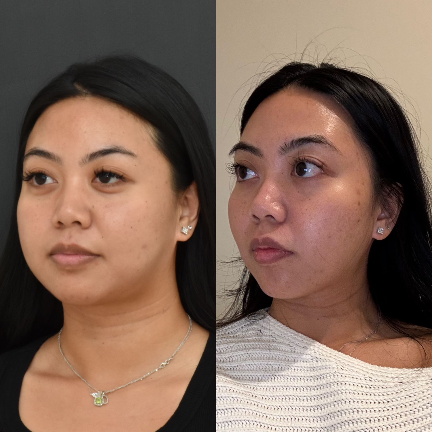 Buccal Fat Removal Before & After