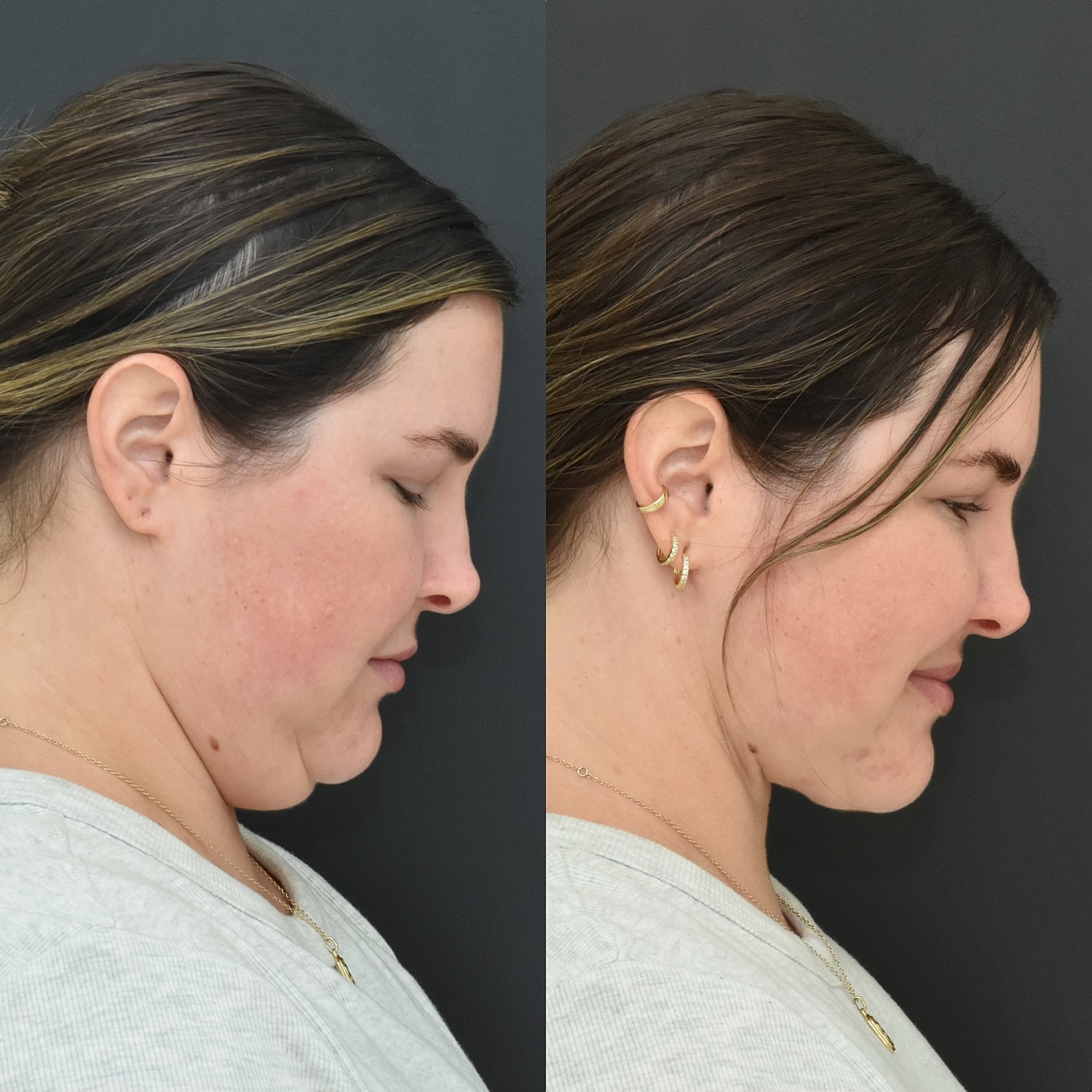 Buccal Fat Removal Before & After