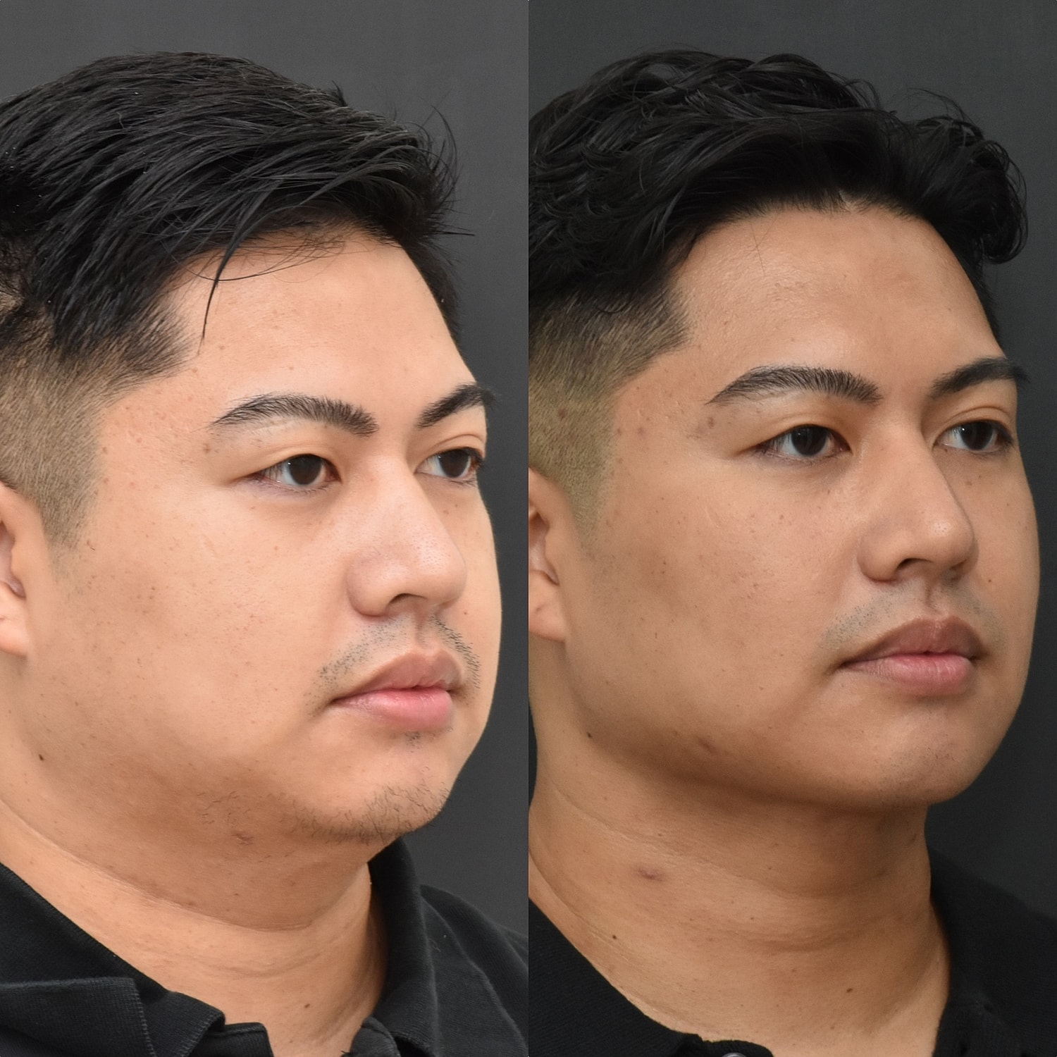 Buccal Fat Removal Before & After