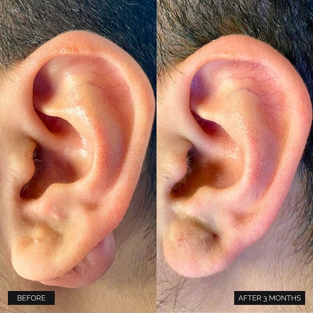 Reconstruction Before & After