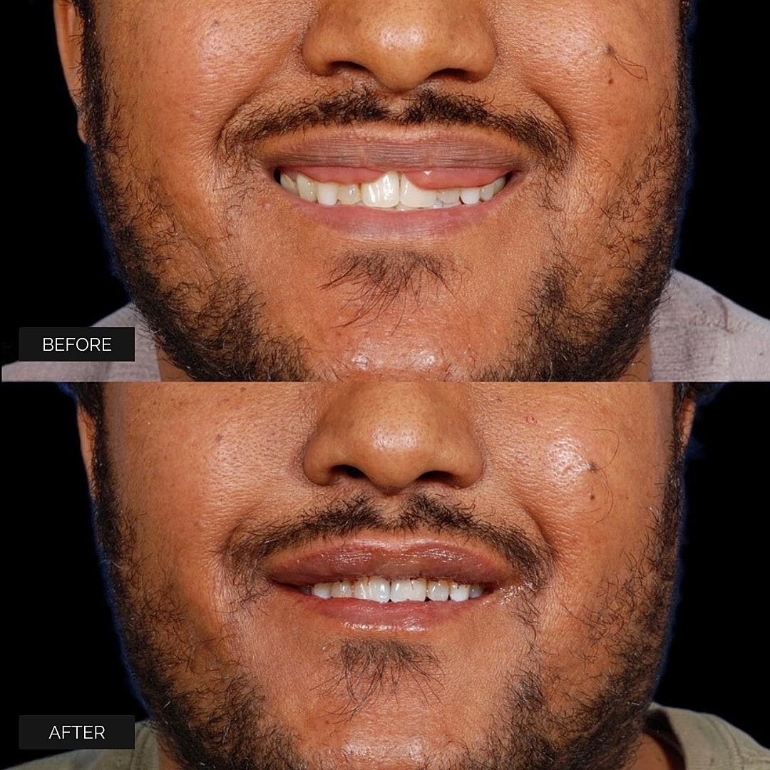 Reconstruction Before & After