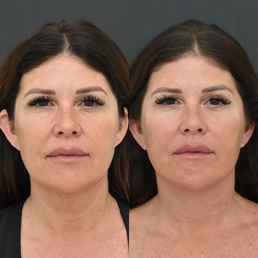 Necklift Before & After