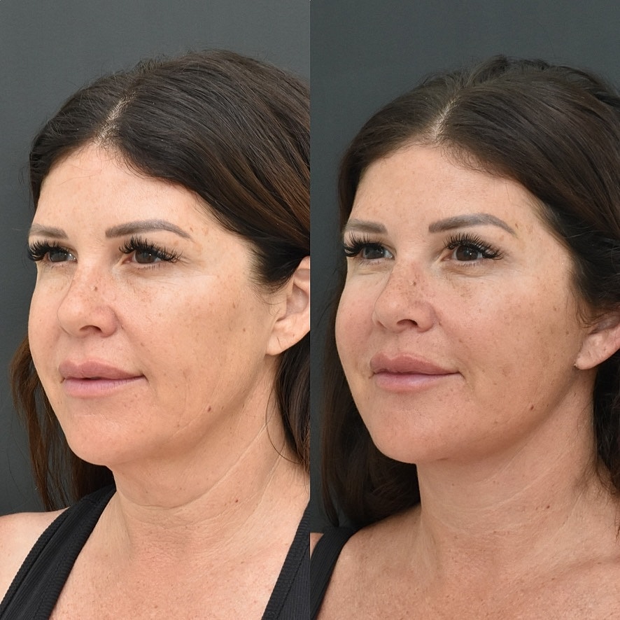 Necklift Before & After