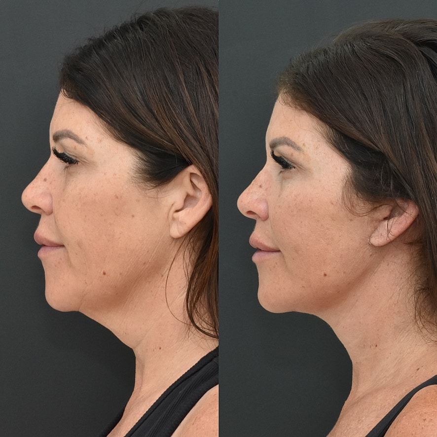 Necklift Before & After