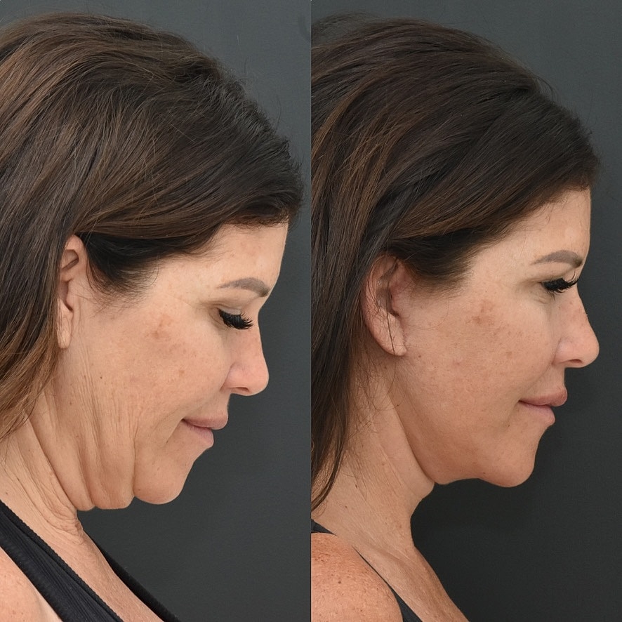 Necklift Before & After