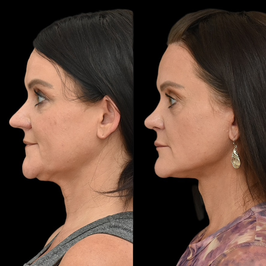 Necklift Before & After