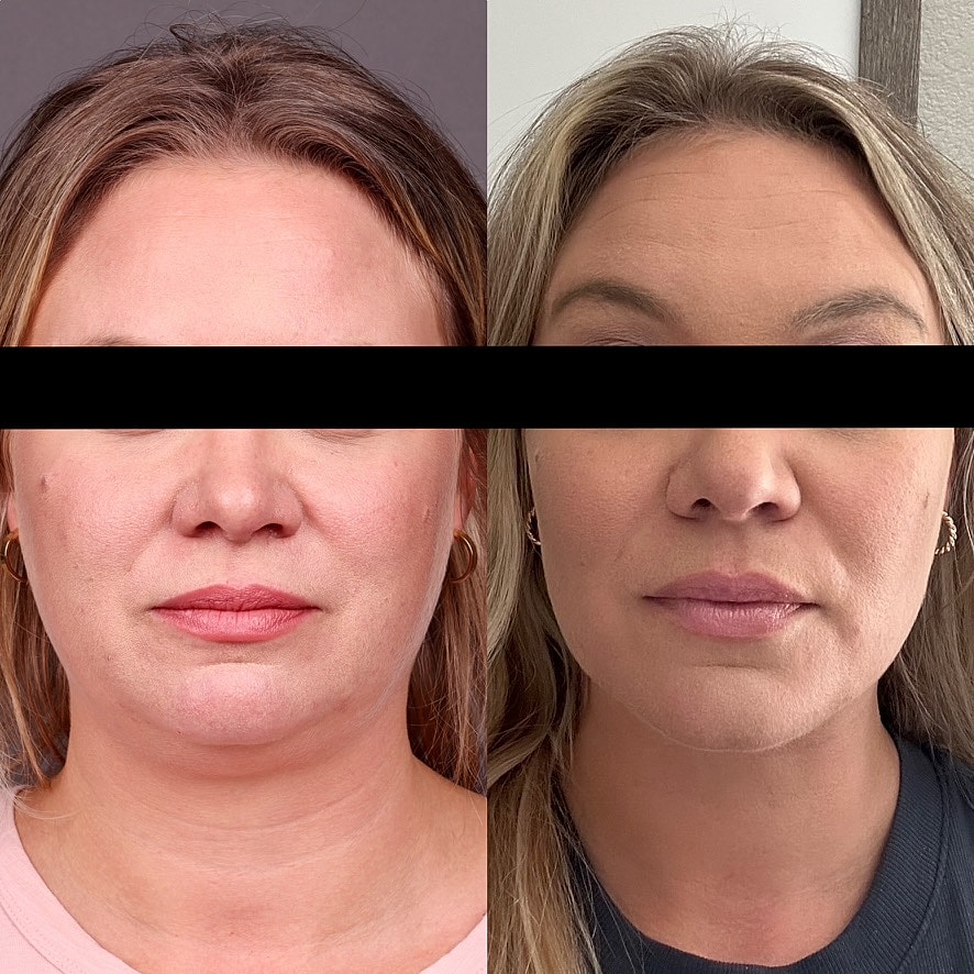 Necklift Before & After