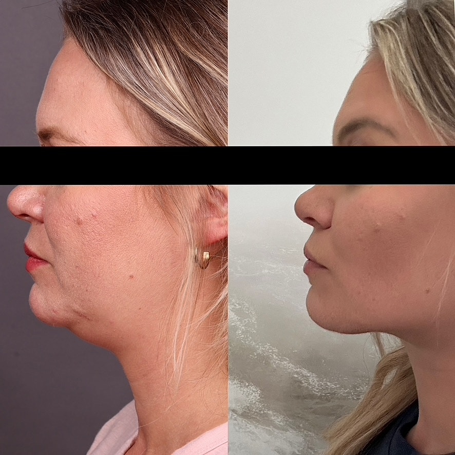 Necklift Before & After