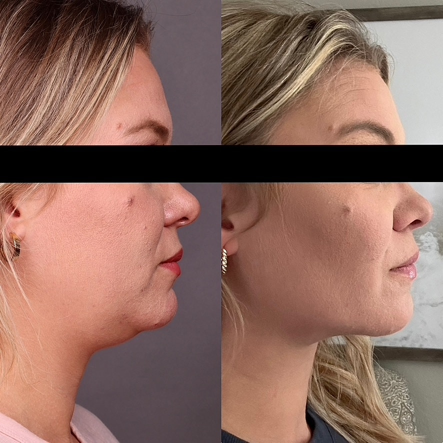 Necklift Before & After