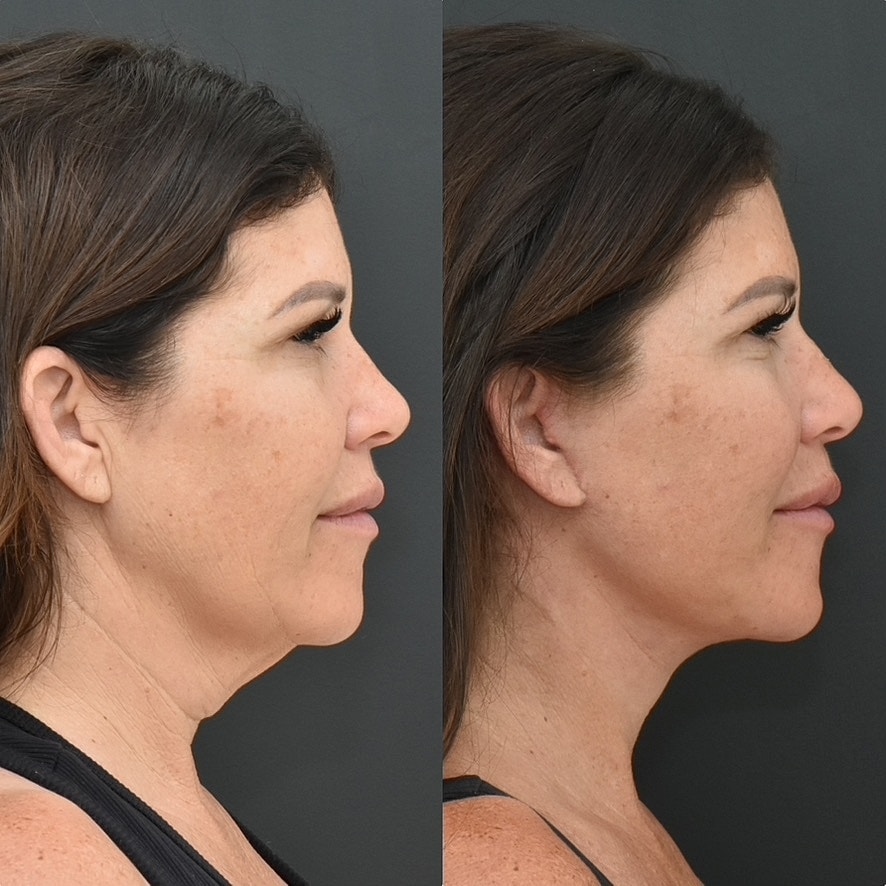 Necklift Before & After