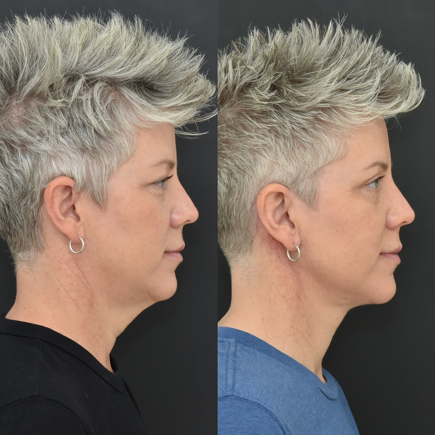 Necklift Before & After