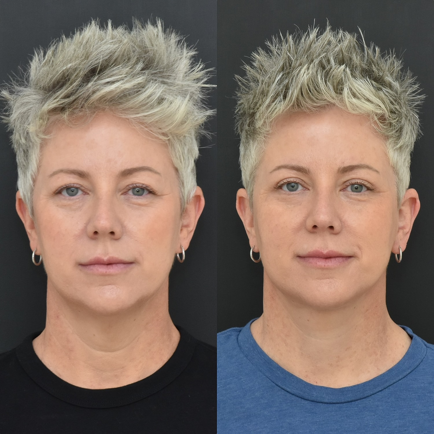 Necklift Before & After