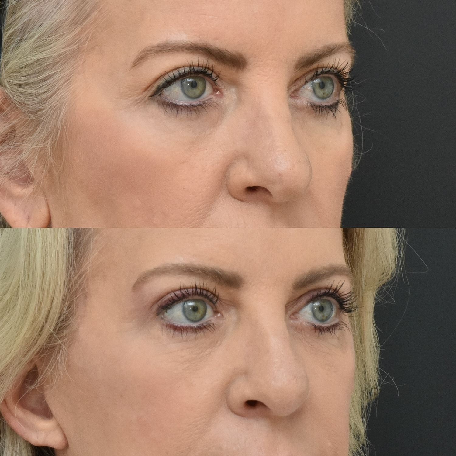 Brow Lift Before & After