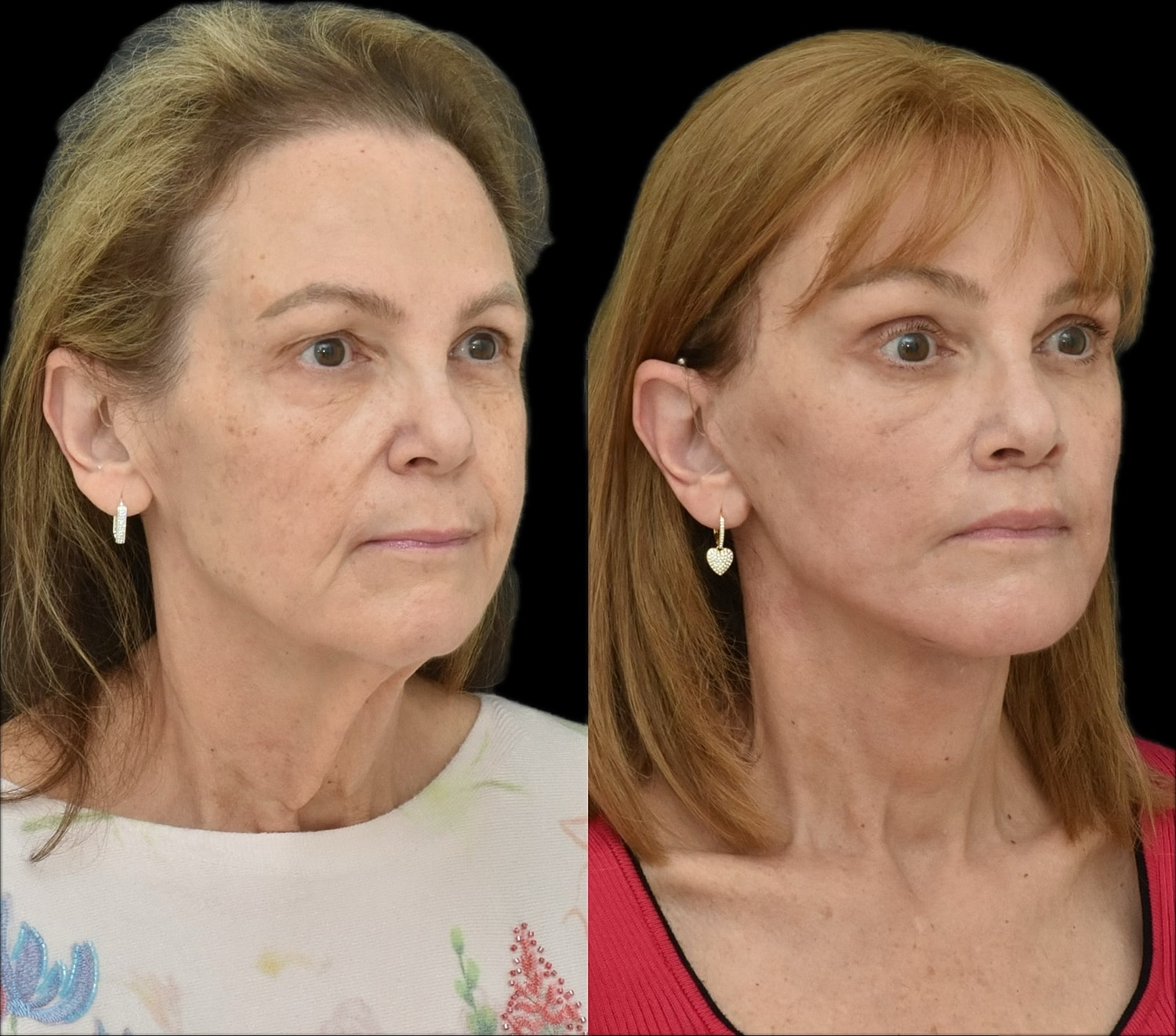 Brow Lift Before & After