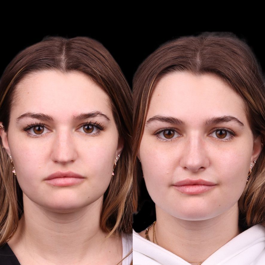 Cosmetic Primary Rhinoplasty Before & After