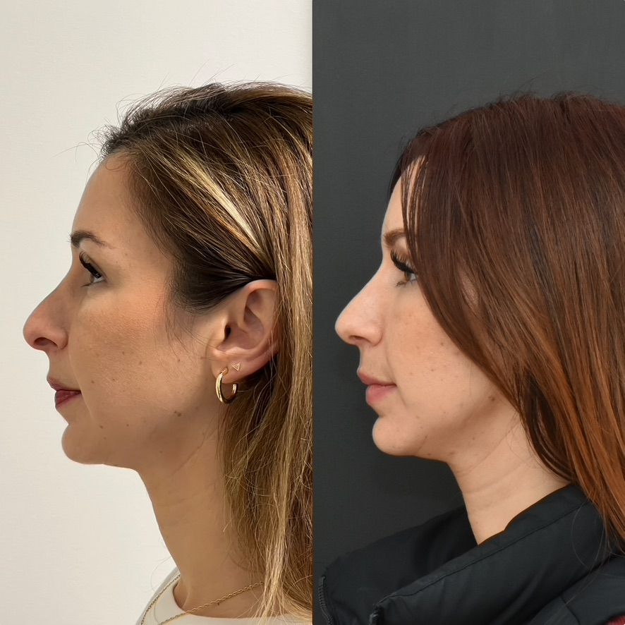 Cosmetic Primary Rhinoplasty Before & After