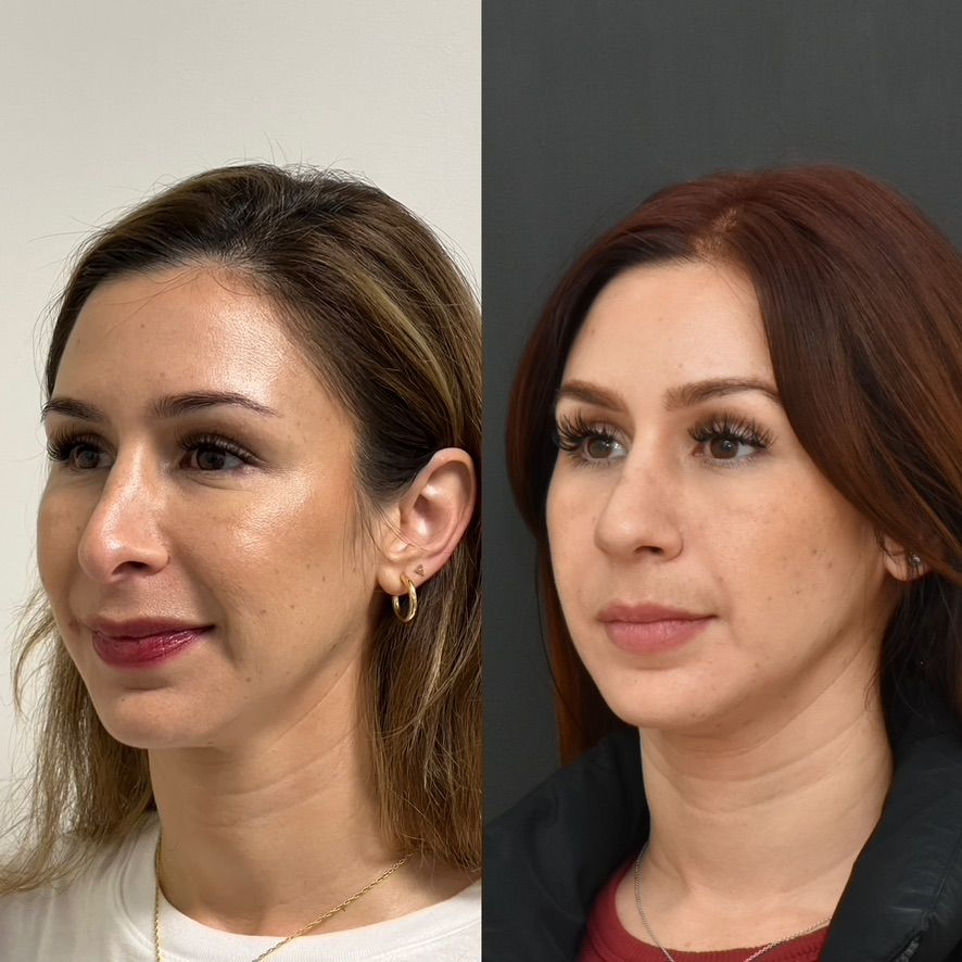 Cosmetic Primary Rhinoplasty Before & After