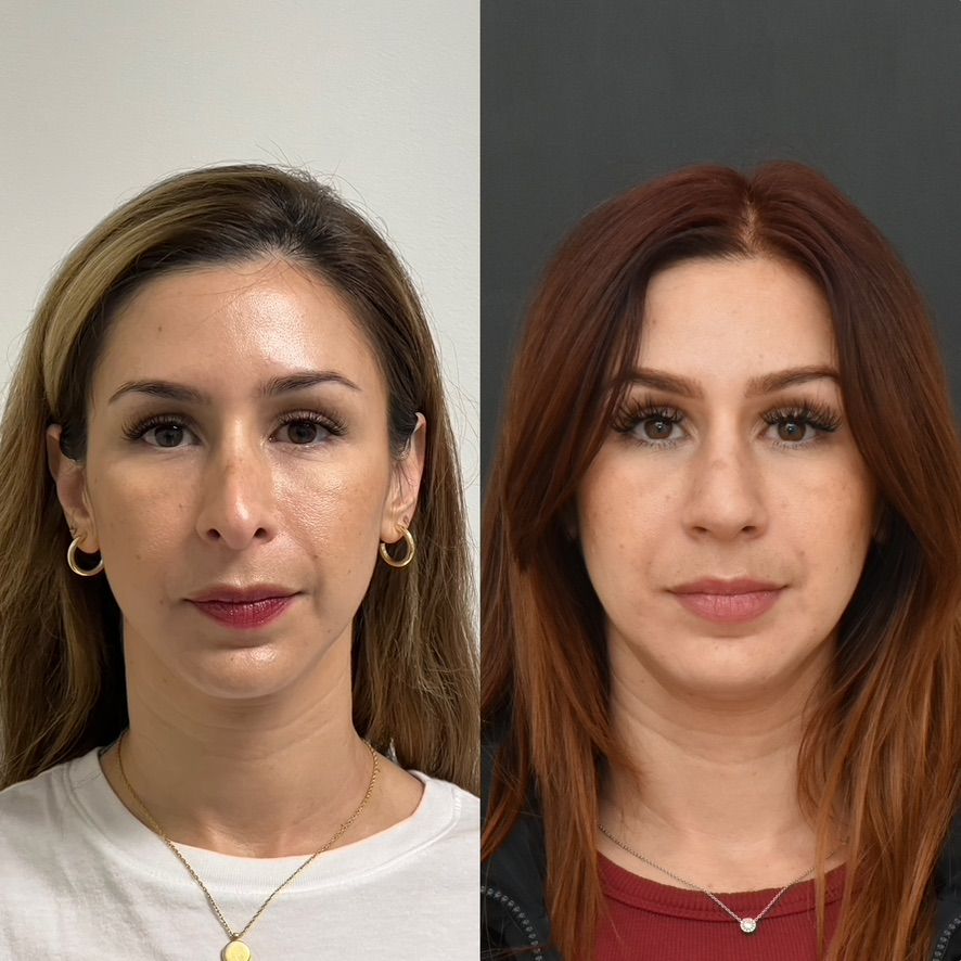 Cosmetic Primary Rhinoplasty Before & After