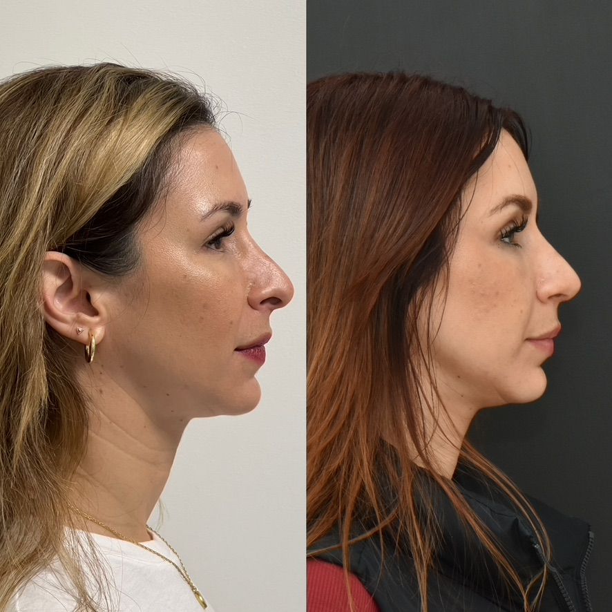 Cosmetic Primary Rhinoplasty Before & After