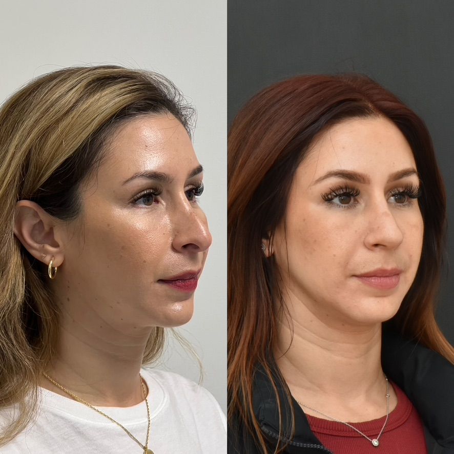 Cosmetic Primary Rhinoplasty Before & After