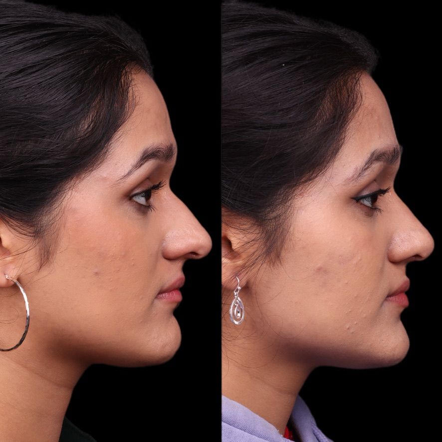 Cosmetic Primary Rhinoplasty Before & After