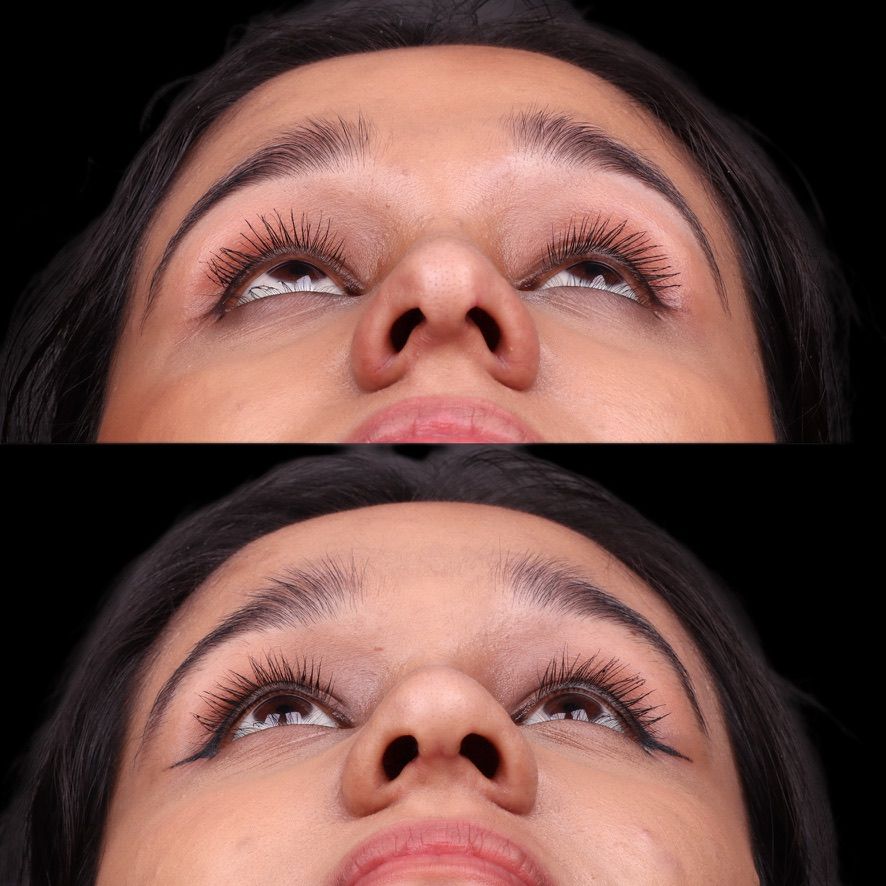 Cosmetic Primary Rhinoplasty Before & After