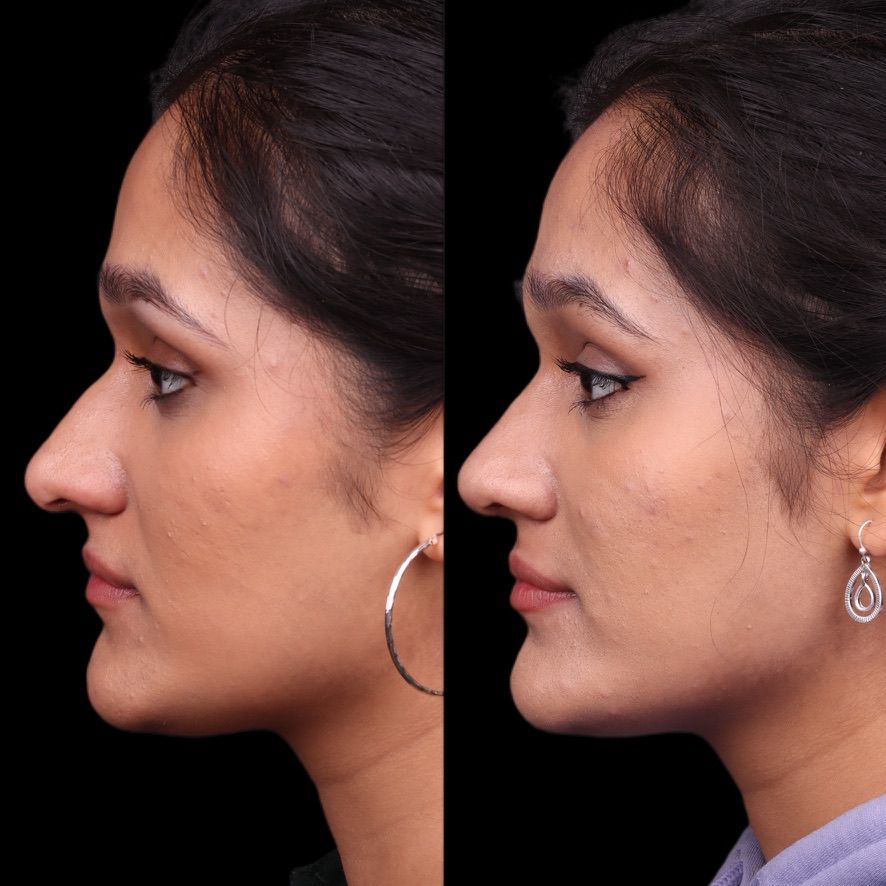 Cosmetic Primary Rhinoplasty Before & After
