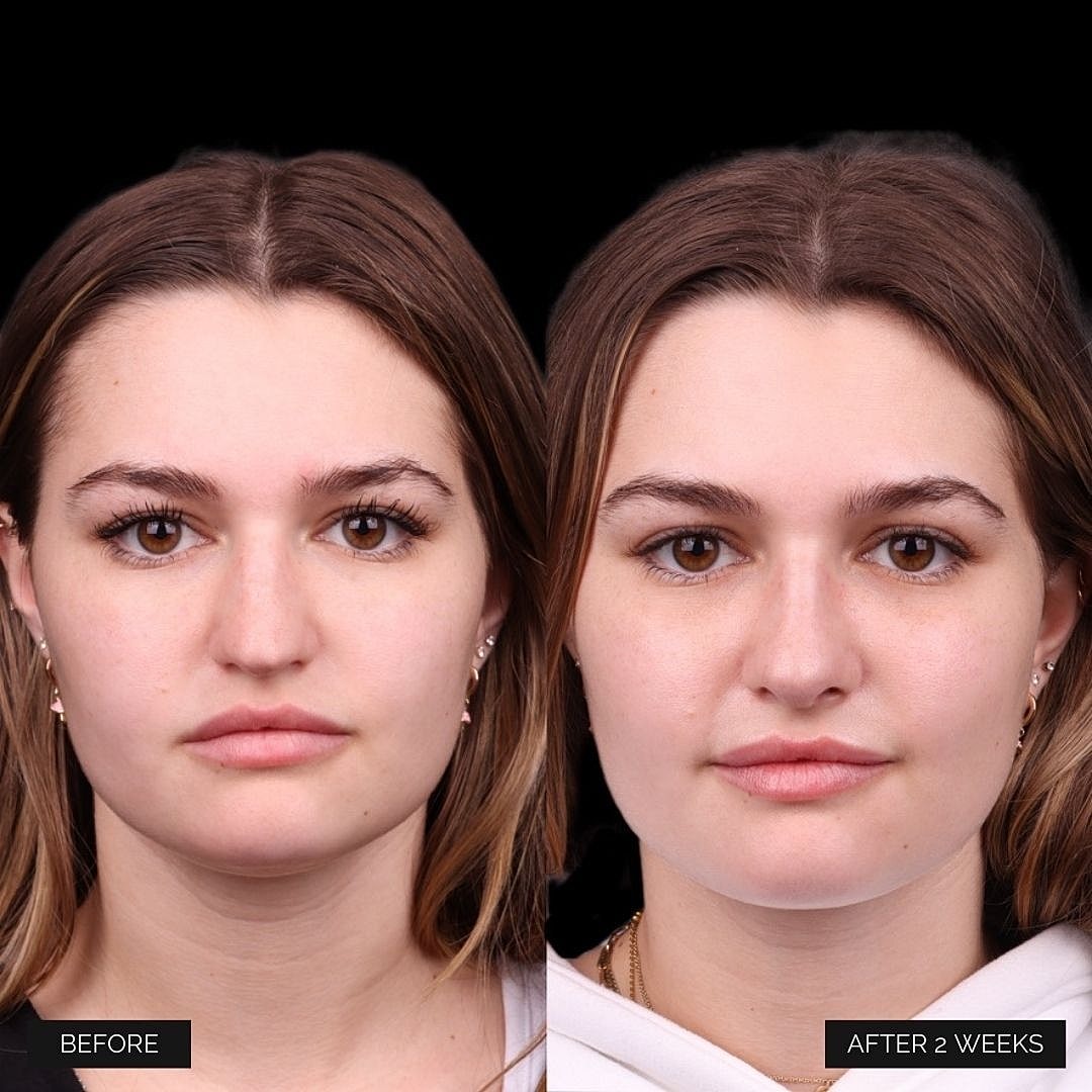 Cosmetic Primary Rhinoplasty Before & After