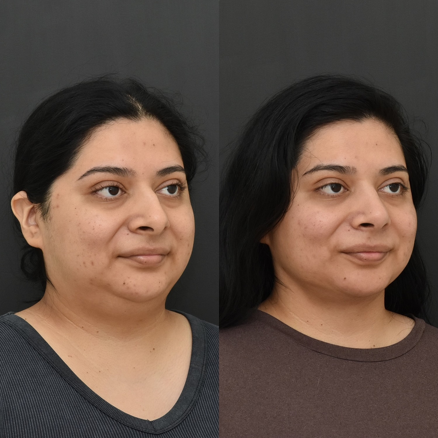 Cosmetic Primary Rhinoplasty Before & After