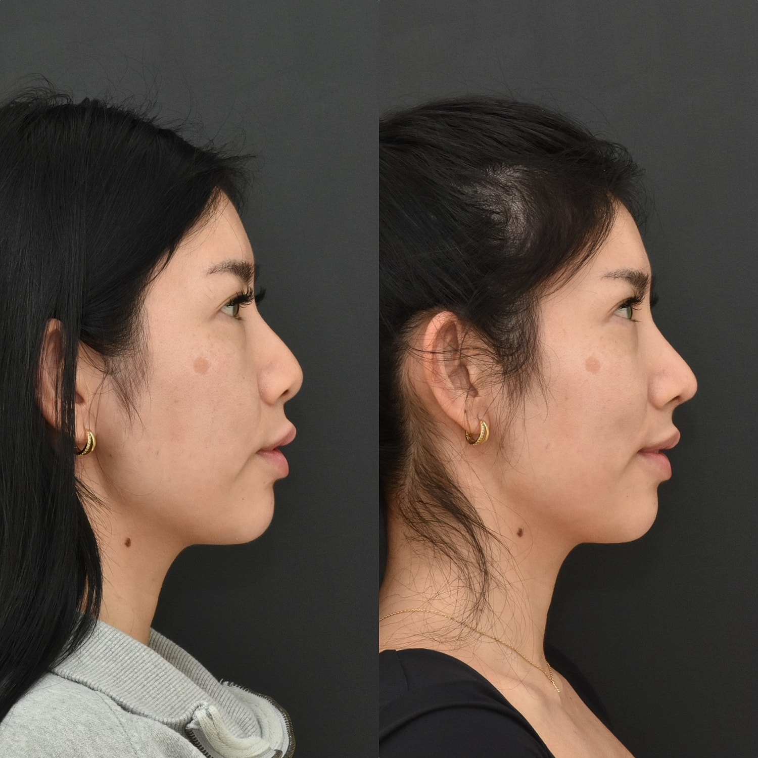 Cosmetic Primary Rhinoplasty Before & After