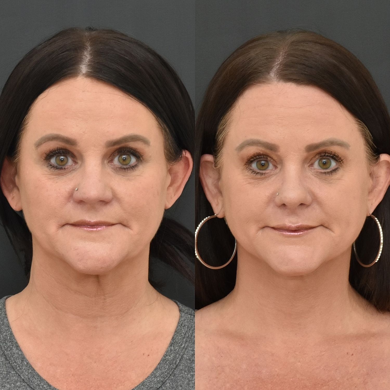 Cosmetic Primary Rhinoplasty Before & After