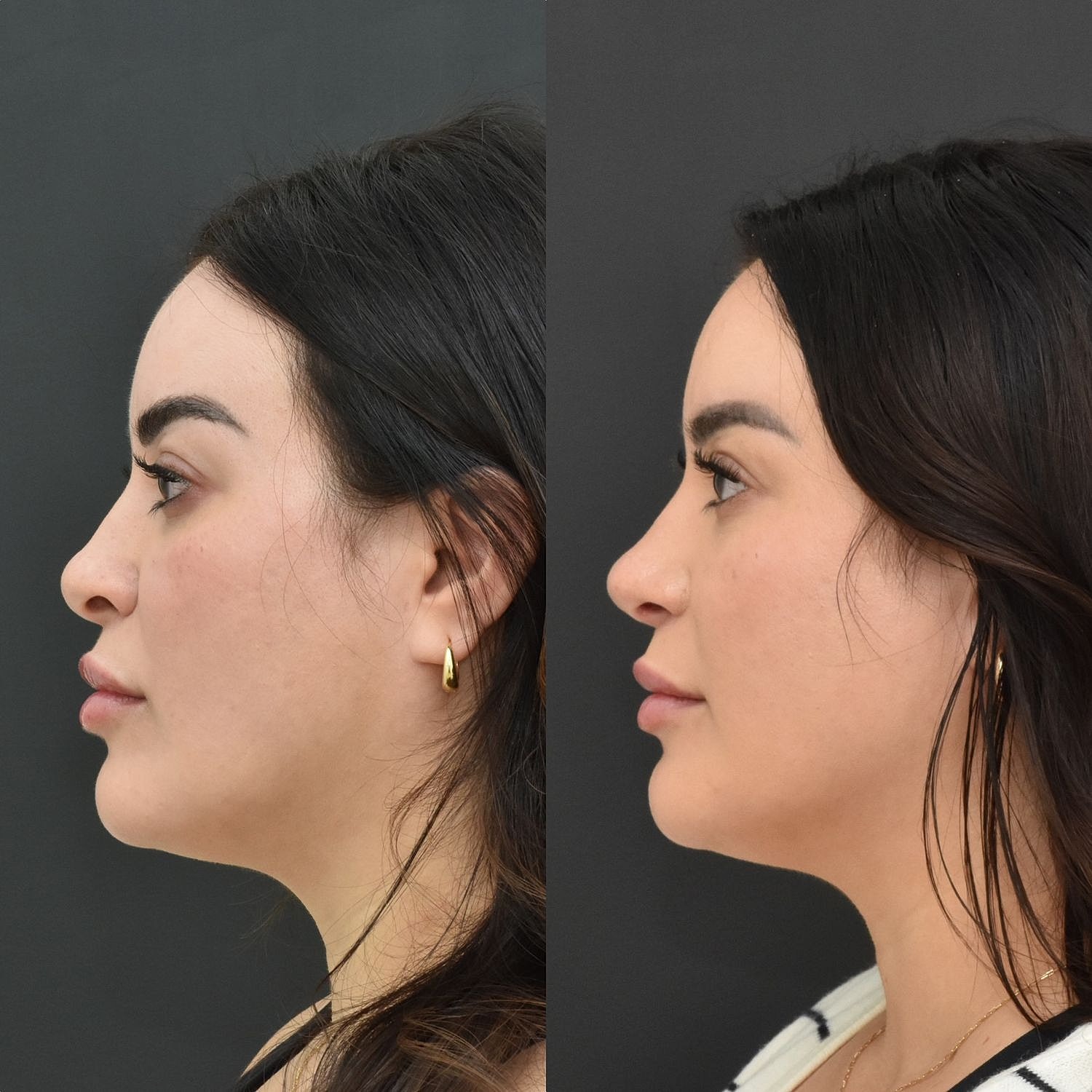 Cosmetic Primary Rhinoplasty Before & After