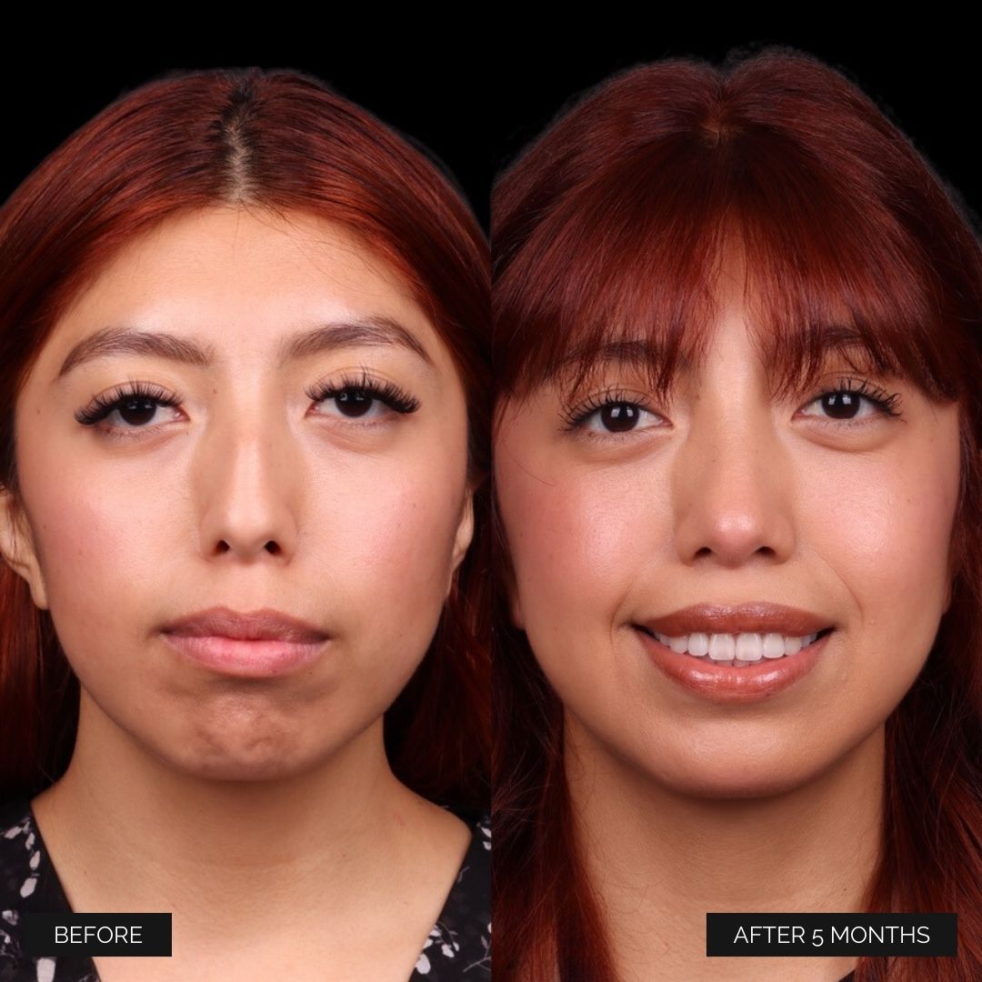Cosmetic Primary Rhinoplasty Before & After