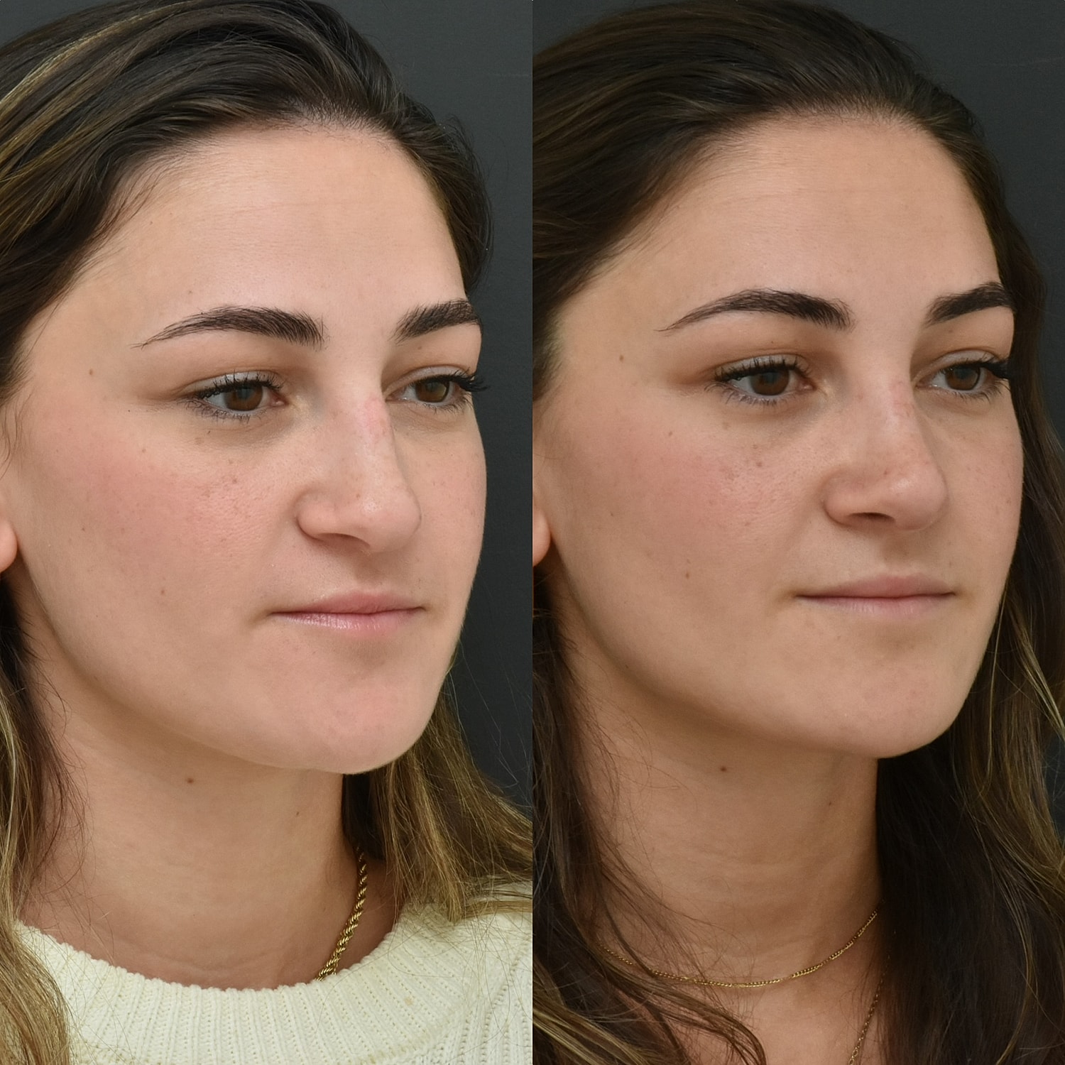 Cosmetic Primary Rhinoplasty Before & After