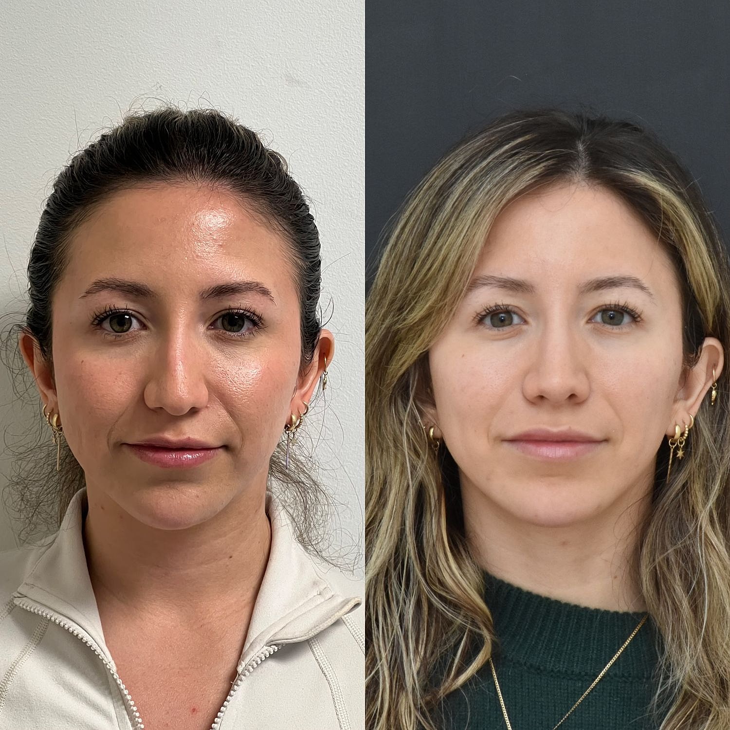 Cosmetic Primary Rhinoplasty Before & After