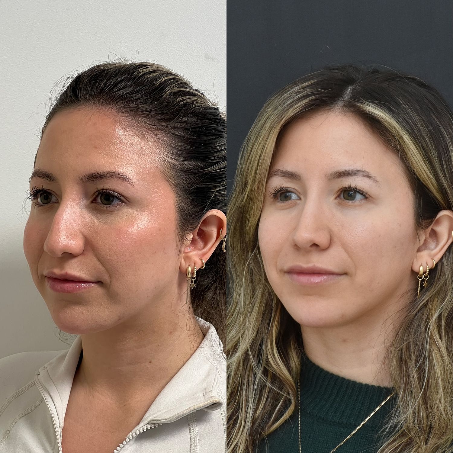 Cosmetic Primary Rhinoplasty Before & After