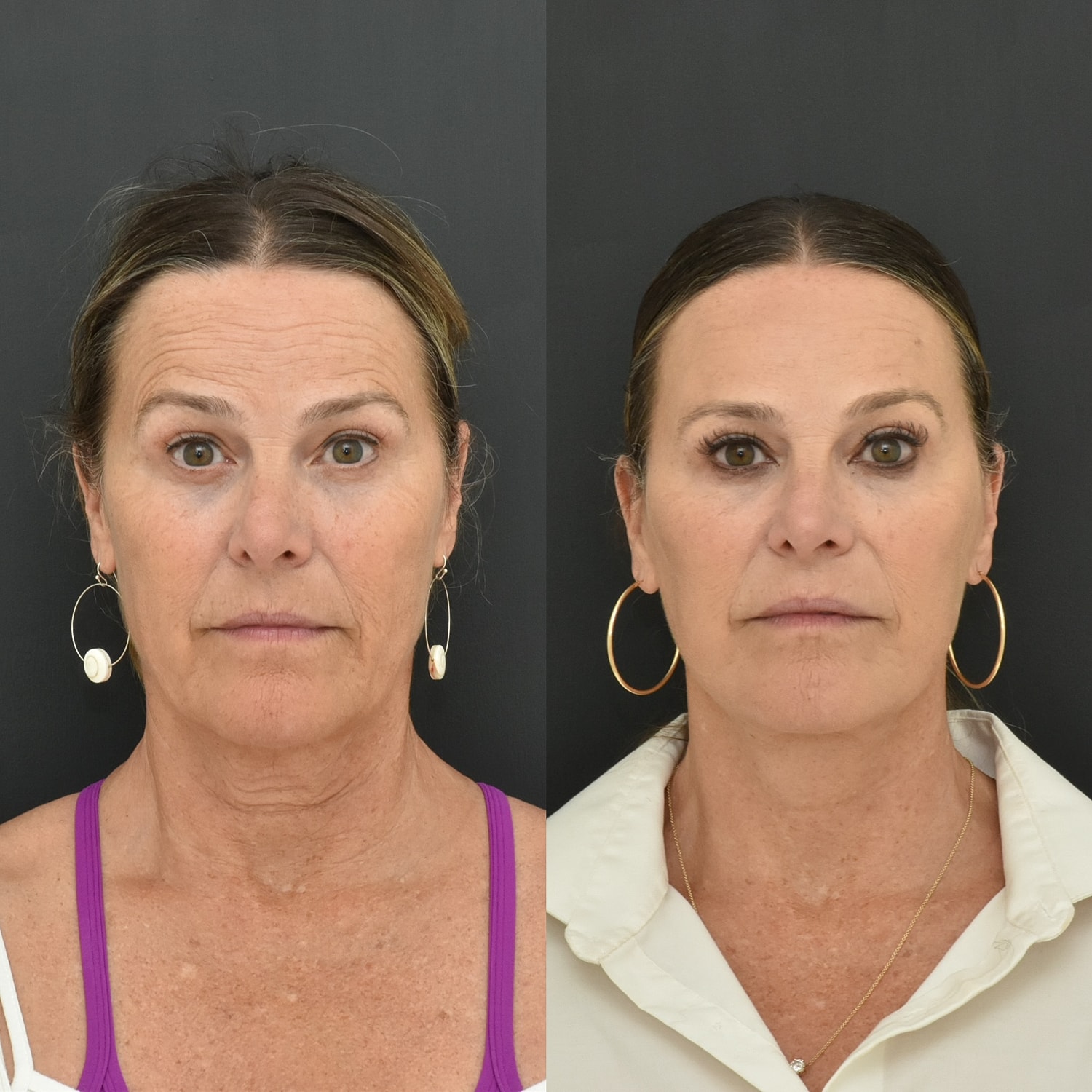 Facelift  Before & After